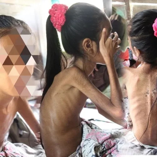 FOTO: Putri Penderita Gizi Buruk dikuti di Laman kitabisa.com