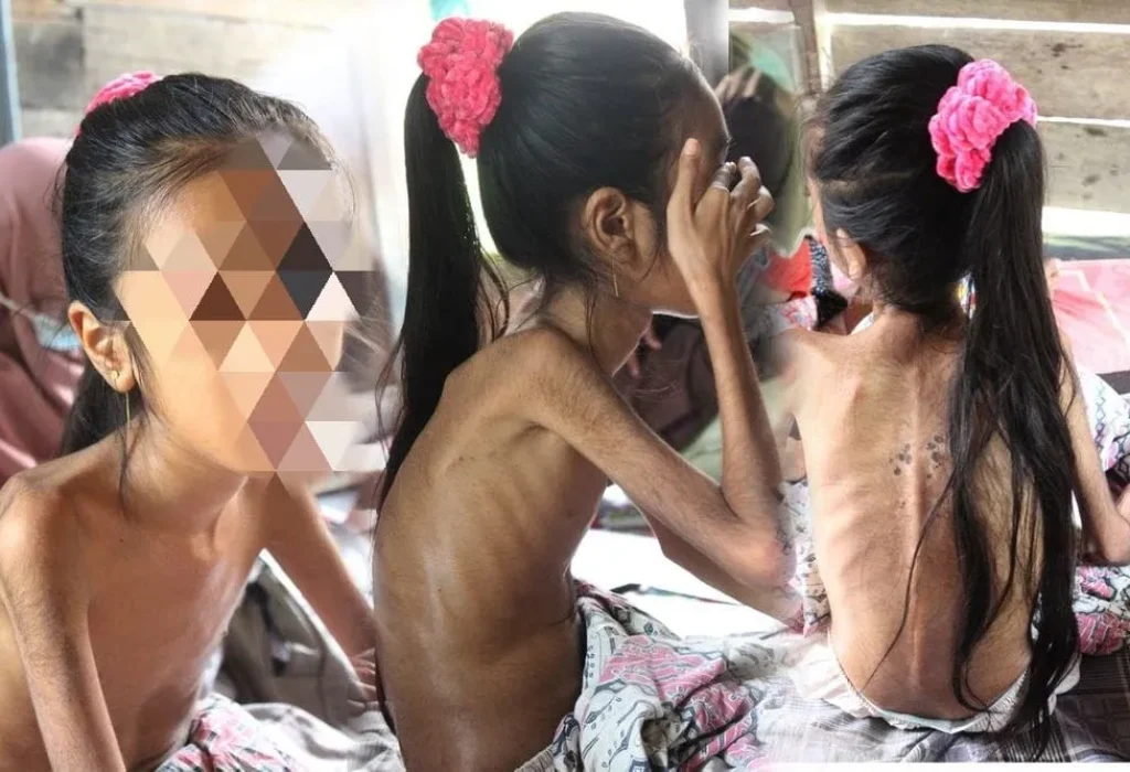 FOTO: Putri Penderita Gizi Buruk dikuti di Laman kitabisa.com